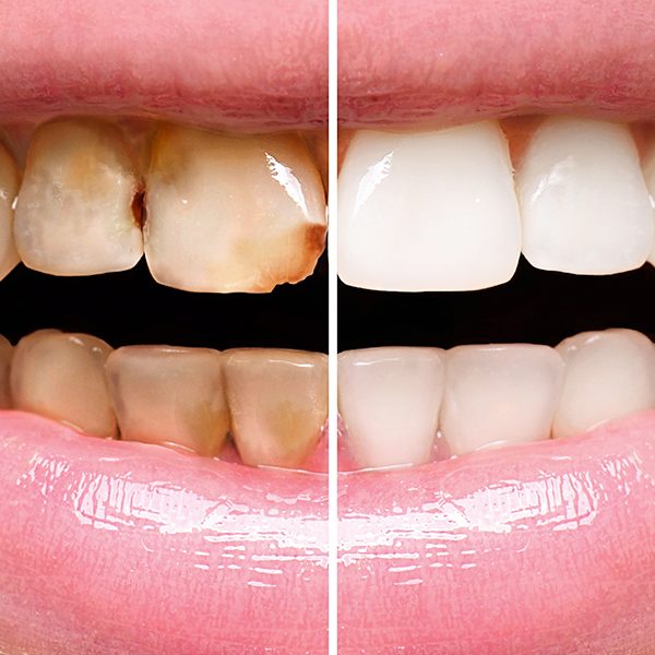 restorative-dentistry-crown-dental